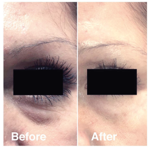 lighteyes before and after 2